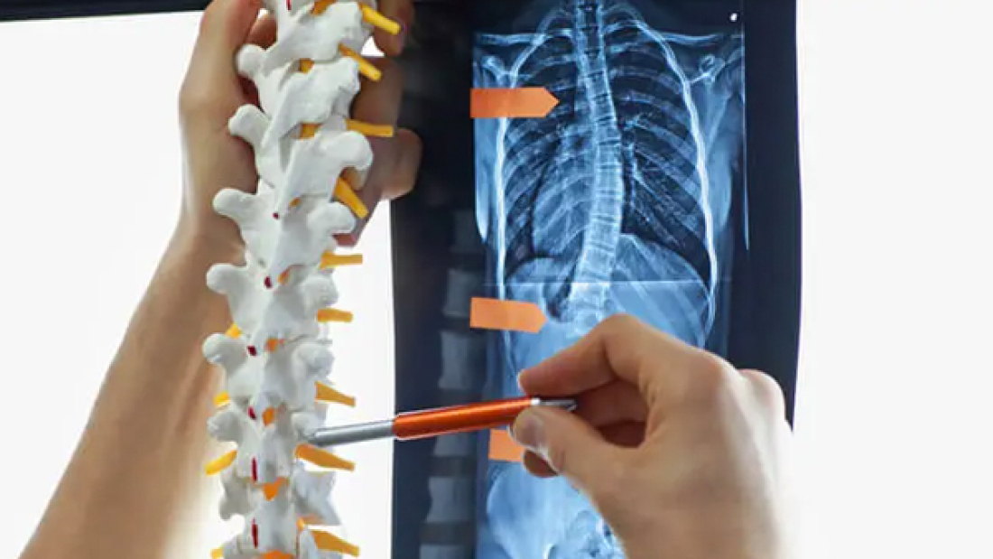 Hernia-Discal